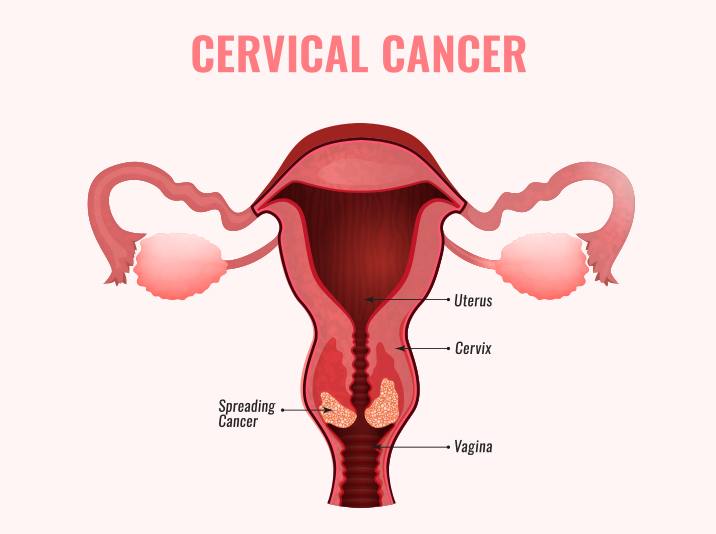 Cervical Cancer