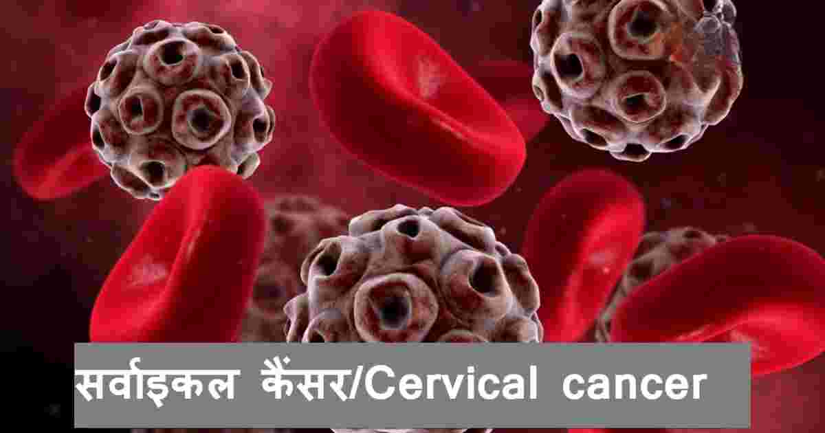 Cervical cancer